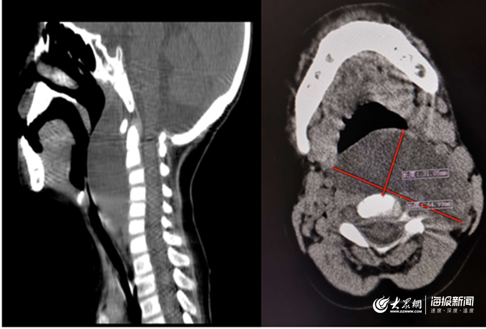 颈部巨大淋巴管瘤险窒息,"微创"精准施治挽救患儿生命