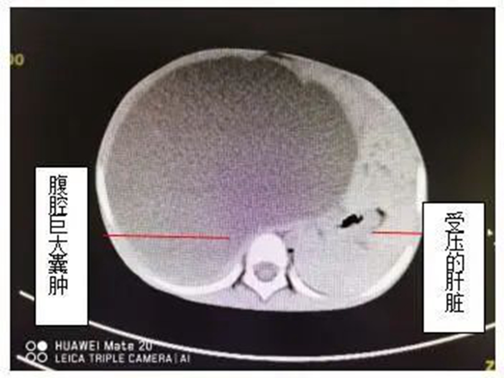 2歲男孩腹脹似青蛙,齊魯(青島)兒外科微創手術解病憂_醫界動態_大眾網
