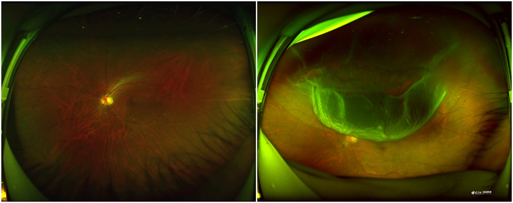 入院手术出院24小时内搞定青岛眼科医院日间手术扩容至15个病种